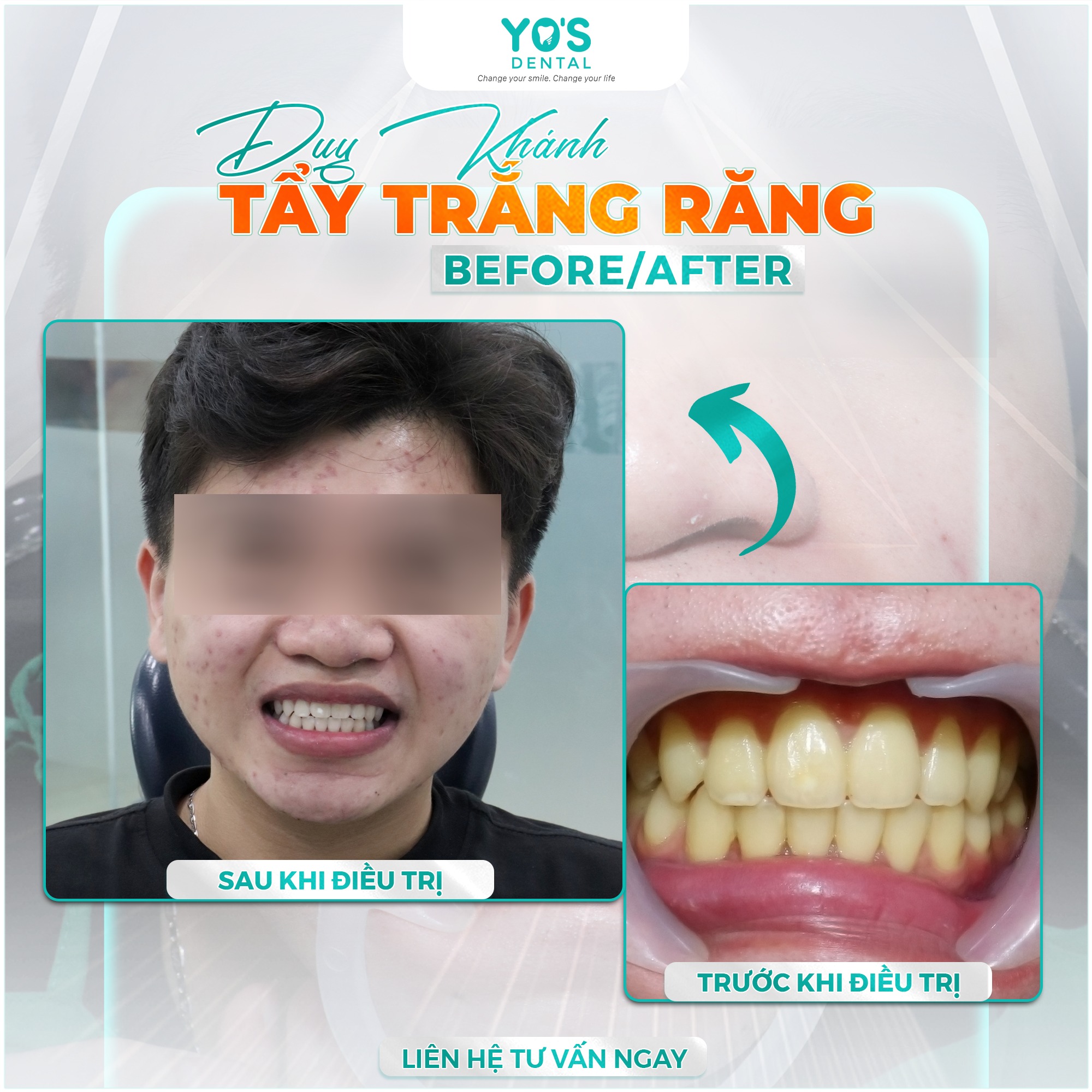 Khách hàng Duy Khánh tẩy trắng răng